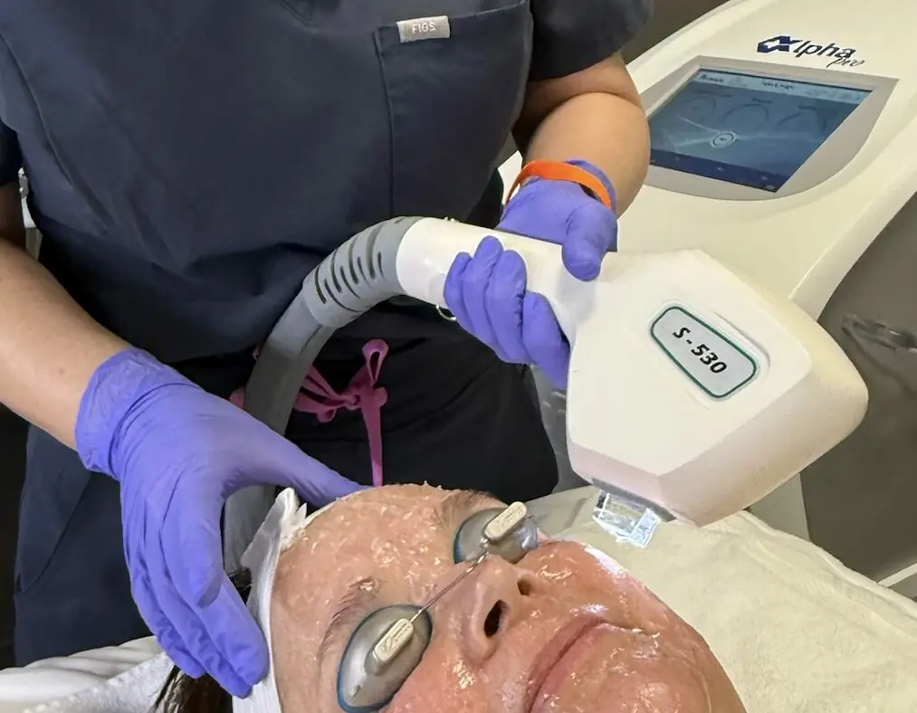 Laser skin resurfacing treatment in Vancouver, WA
